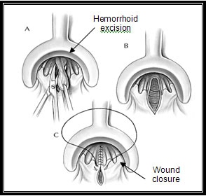 Closed hemorrhoidectomy